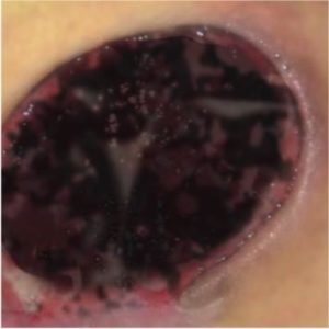 leczenie_ran_przewl_w_srod_wilgot_1