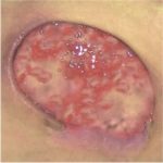 leczenie_ran_przewl_w_srod_wilgot_6