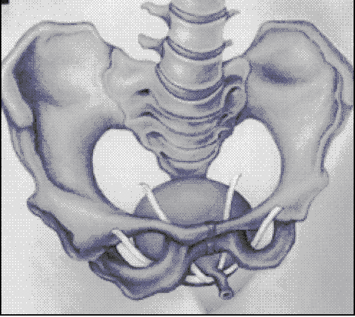 Charakterystyka metod implantacyjnych TOT i TVT