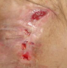 Odleżyny_html_635c7d2c